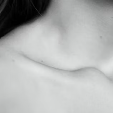 아토피 피부염 진단 기준 치료법 합병증