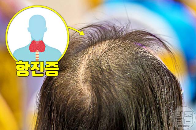 갑상선 기능 항진증 증상 갑상선기능항진증 자가진단 탈모