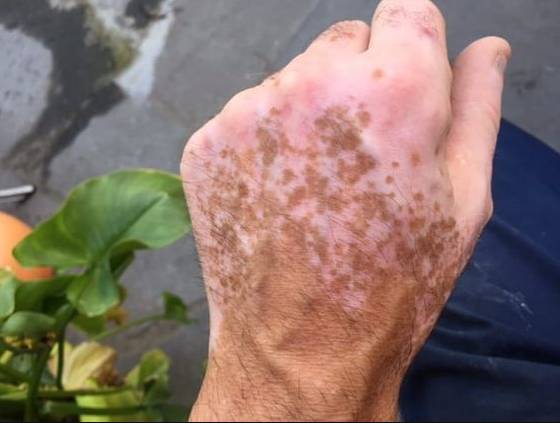 백반증 증상 손부위 (사진 : Pinterest)