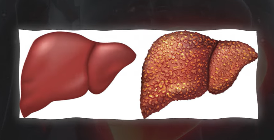 지방간 없애는 방법