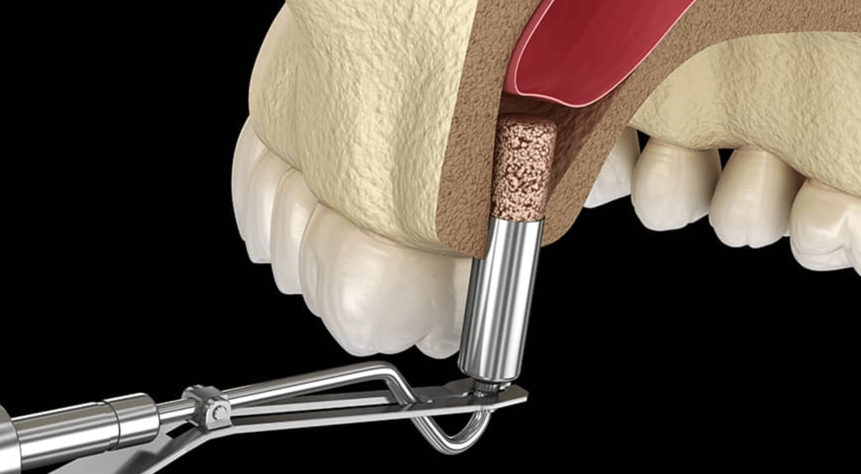 상악동 거상술 방법