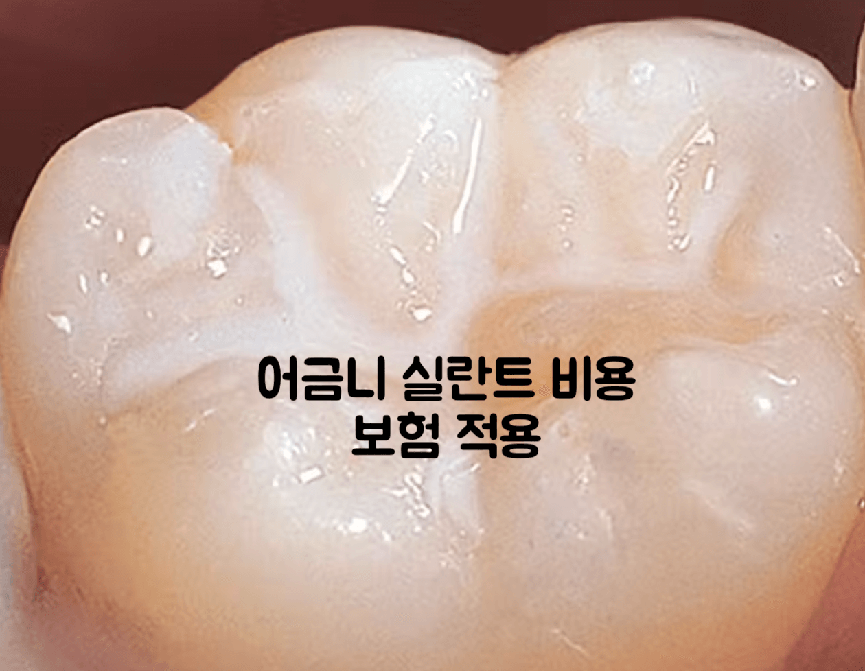 실란트
