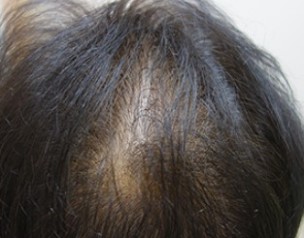머리카락 빠짐이 심할 때 필요한 원인 분석과 관리법
