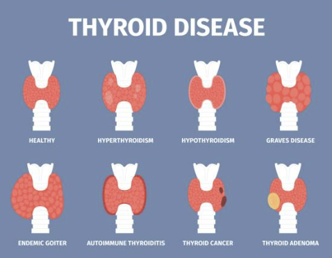 갑상선 기능저하증 증상 좋은 음식 수치 등 알아보기 (24년 Ver)