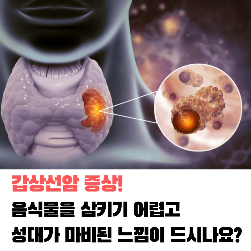 갑상선암-증상-원인-치료