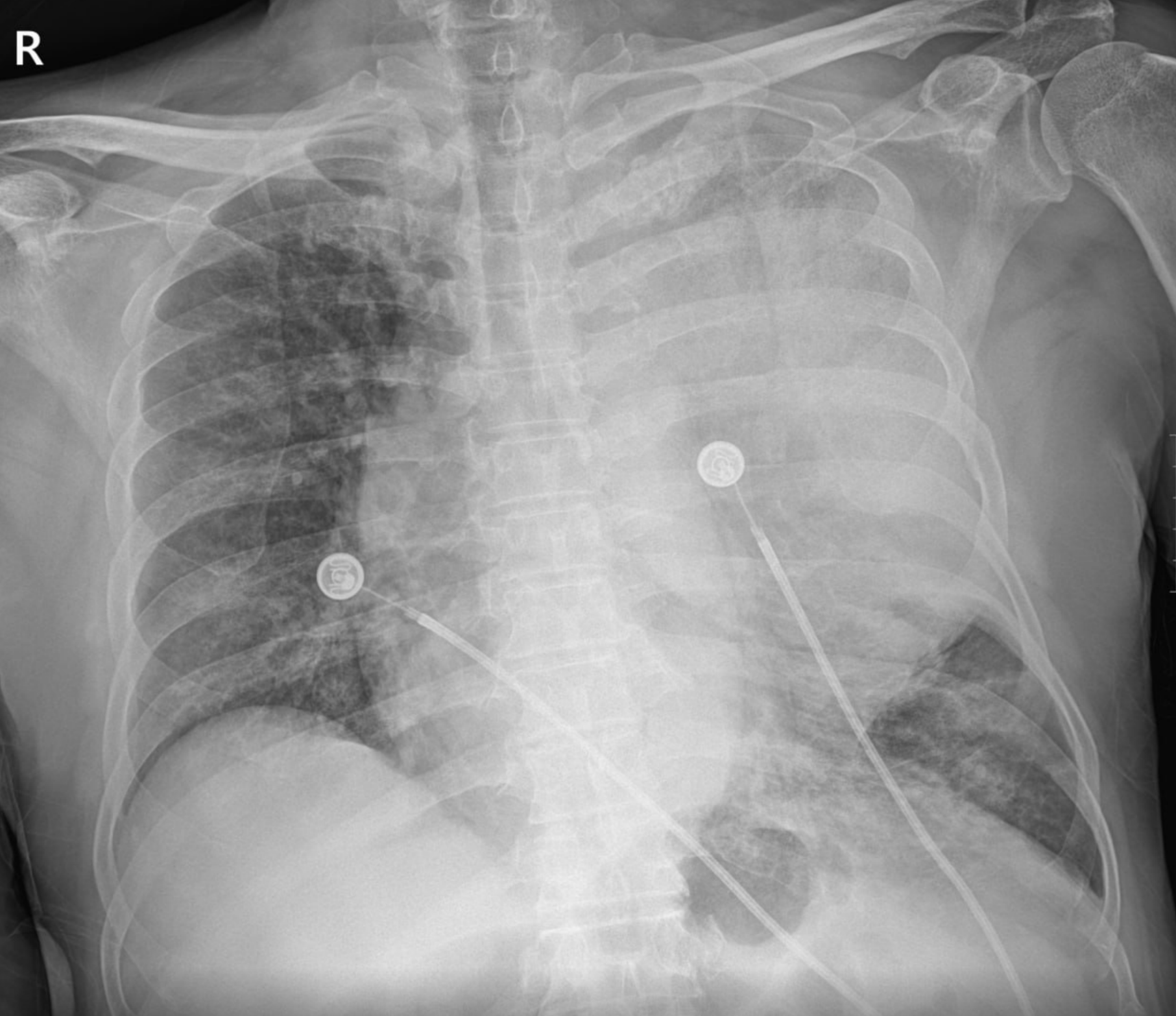 descending thoracic aorta rupture