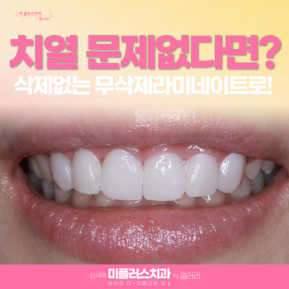가지런하고 하얀 치아의 라미네이트 후의 사진을 공개