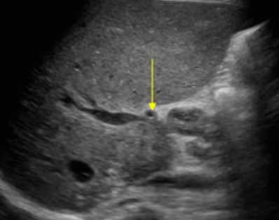  간문부 담관암(Klatskin&amp;#39;s tumor = Hilar cholagiocarcinoma)