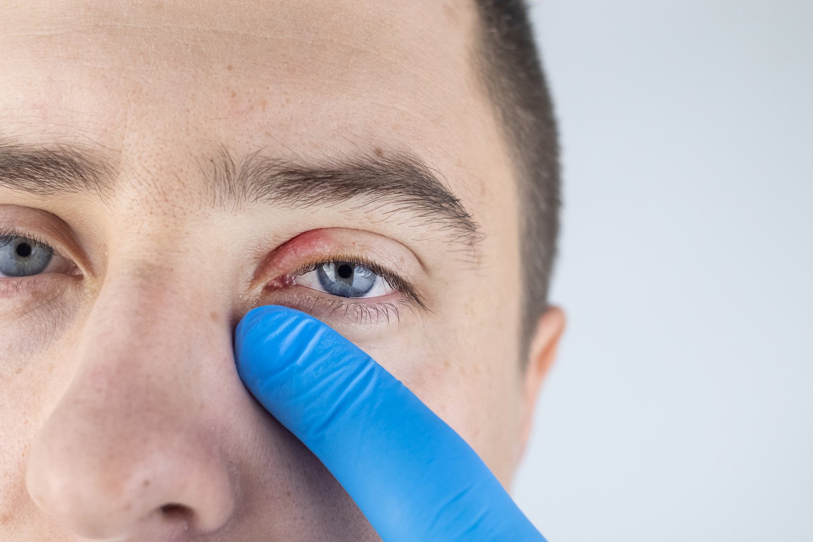 안검염(Blepharitis) – 눈꺼풀 염증 원인 & 치료법