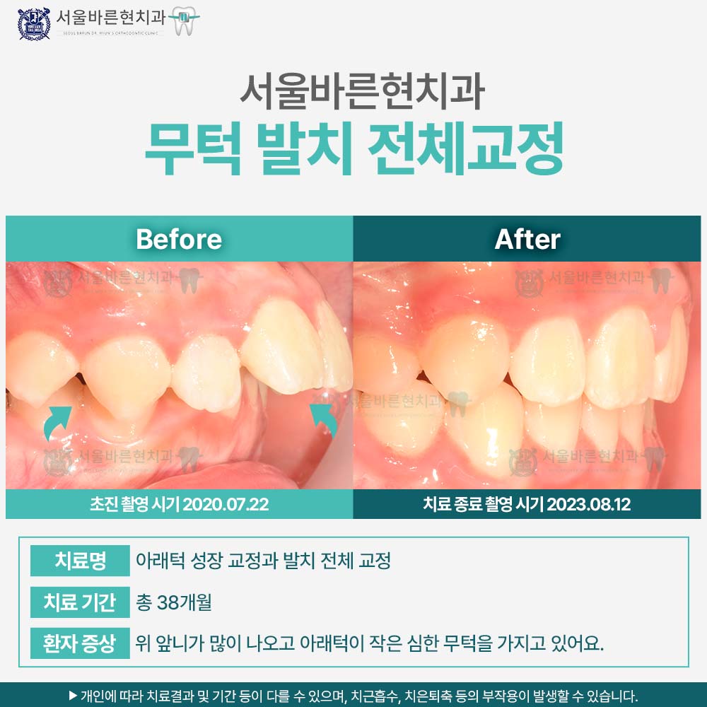 해운대소아교정