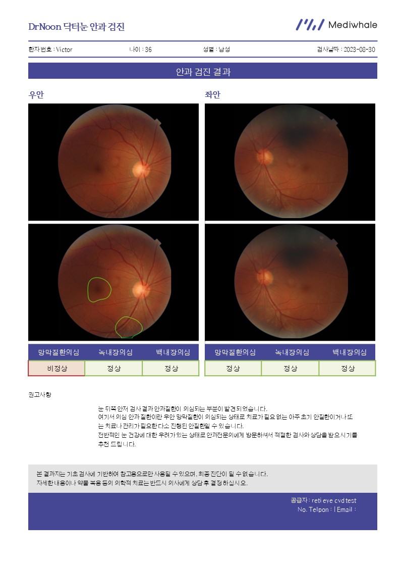 5대 안질환 자동판독 (AI로 정확하게 분석)