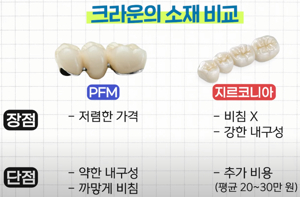 임플란트 가격비교