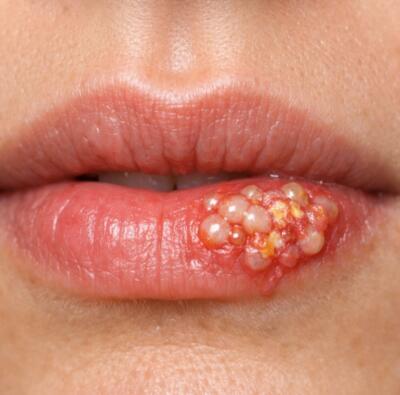 Herpes on the lips