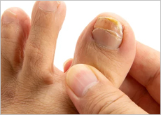 발톱무좀을 가진 사람들의 발 이미지