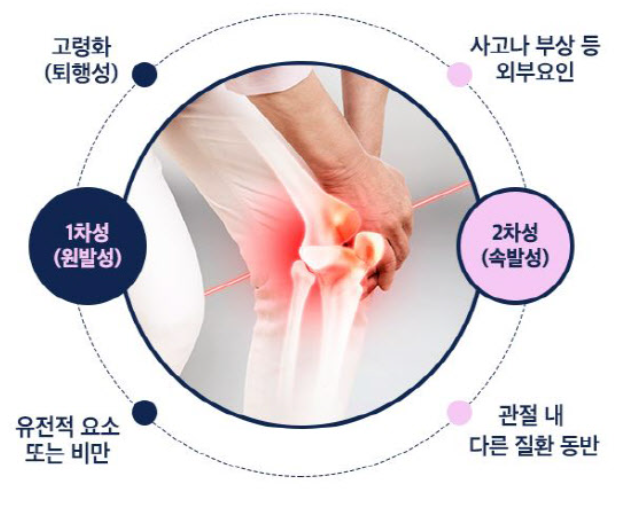 퇴행성 관절염 원인