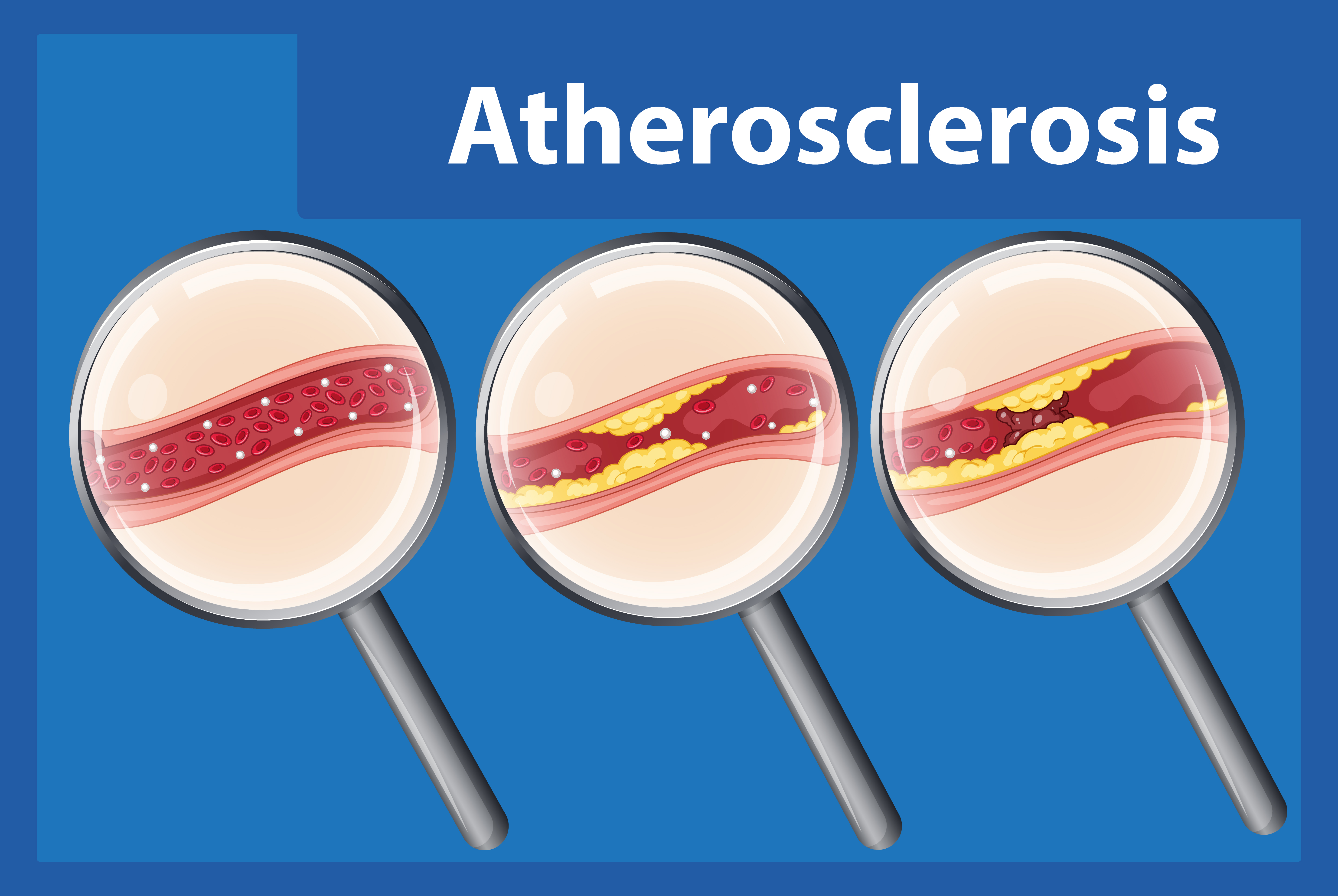 깨끗했던 혈관이 콜레스테롤(노란색)이 혈관내벽에 붙으면서 혈관이 점점 좁아지고&#44; 혈액순환이 잘 되지를 않는다는 이미지