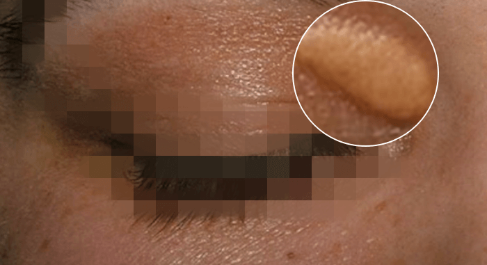 고지혈증증상황색종