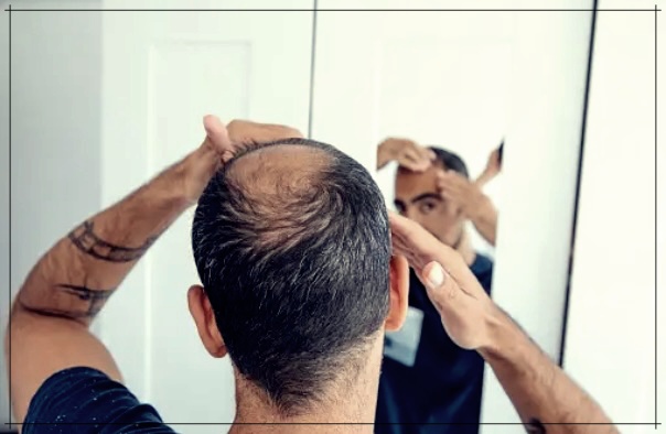 견인성 탈모와 그 원인, 대처 방법.