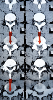 허리디스크 증상