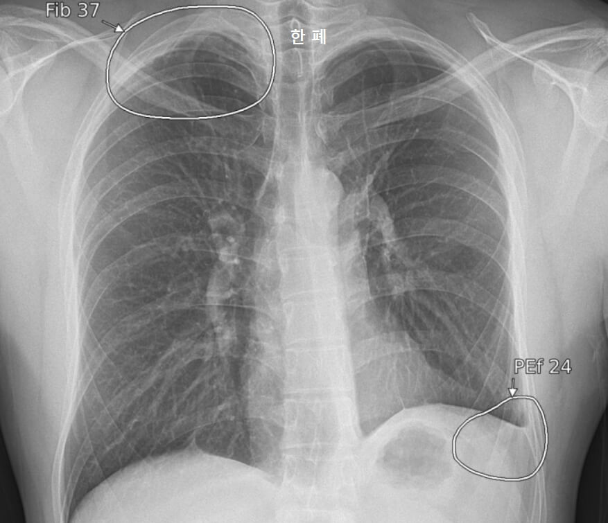 비활동성폐결핵 흉부 X-ray 사진