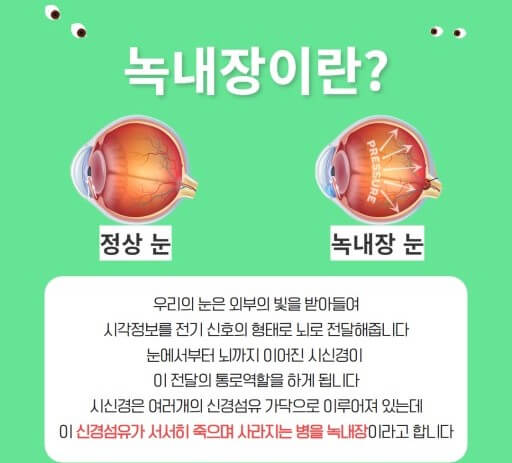녹내장 증상과 치료