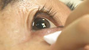 비문증 치료방법