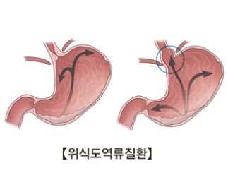 역류성식도염
