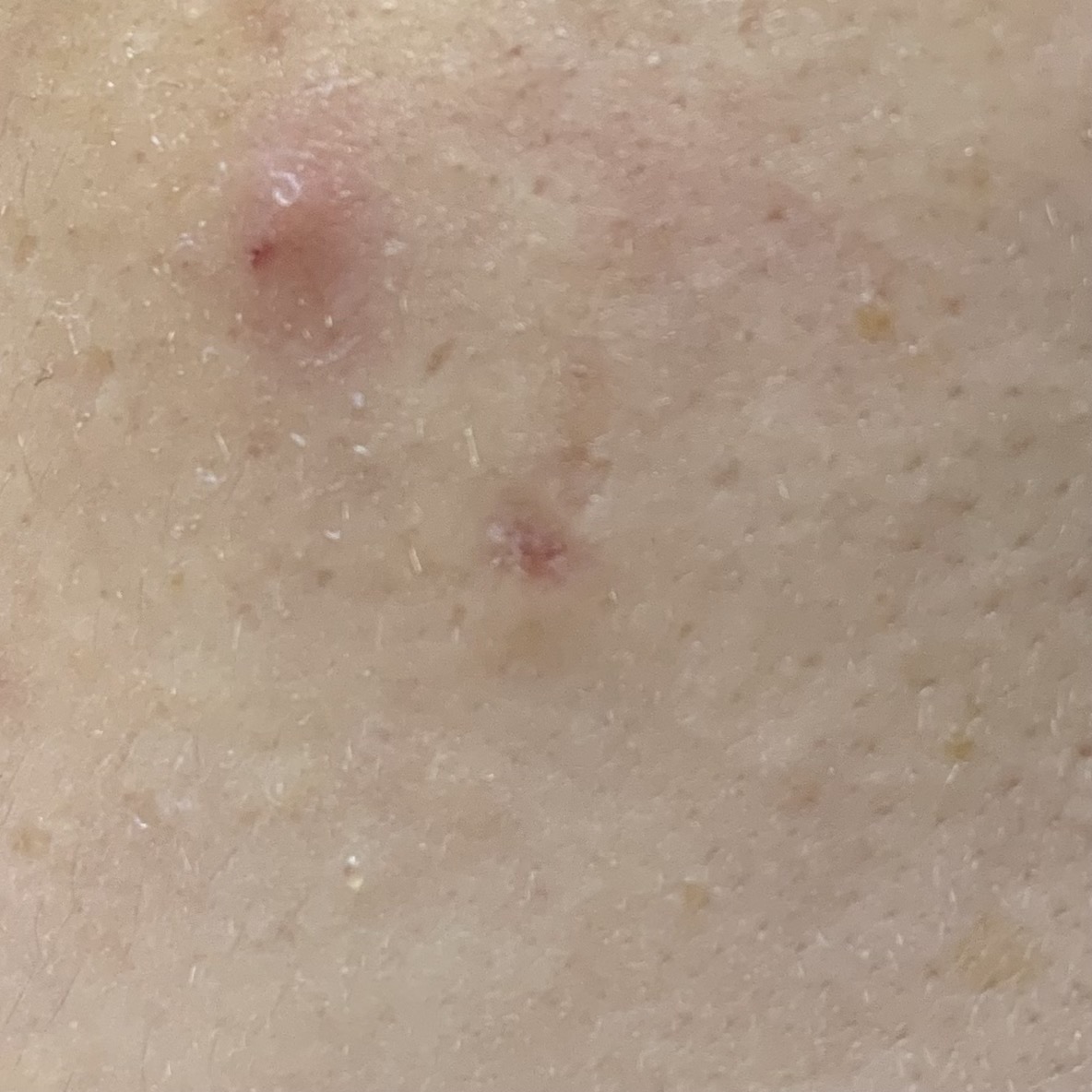 피지낭종 수술30일차