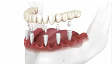 전체 임플란트 가격