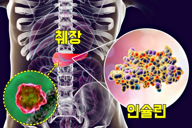 활성산소 췌장 인슐린 조절 베타세포 당뇨, 항산화물질, 건강 팁줌 매일꿀정보