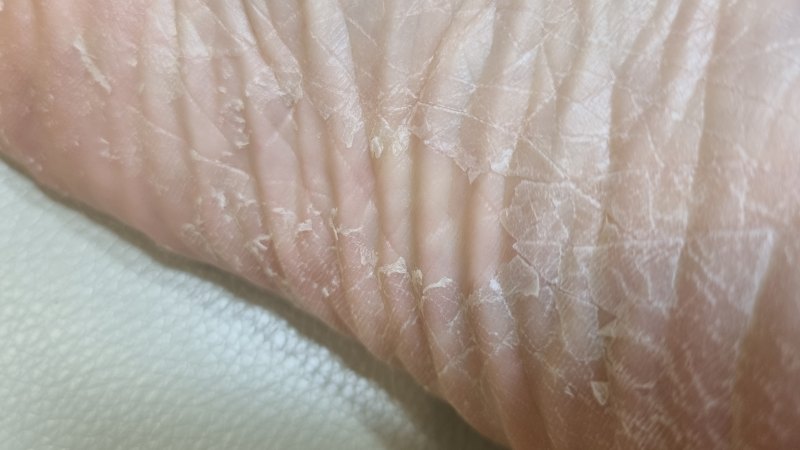 발뒤꿈치 각질 탈락2