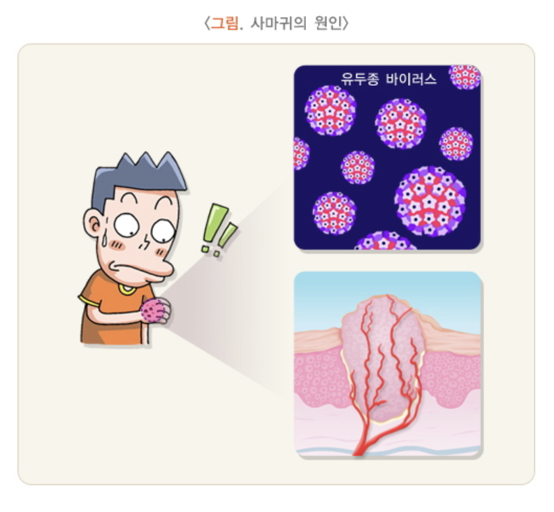 사마귀 원인