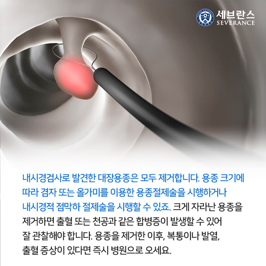 대장내시경에서 발견된 용종 원인과 증상, 예방법