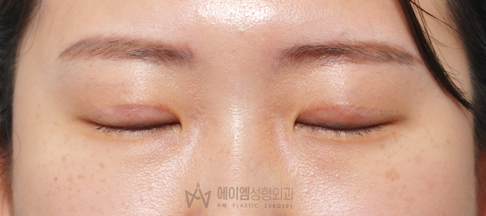 소세지눈 두줄따기 5개월 눈감은사진