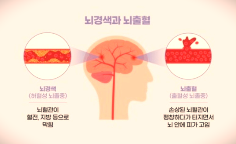 뇌경색 과 뇌출혈 설명 홍보 이미지