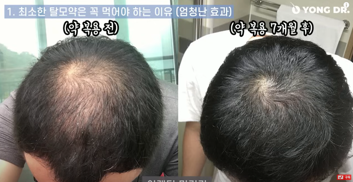 탈모약 효과 7개월 전후 사진