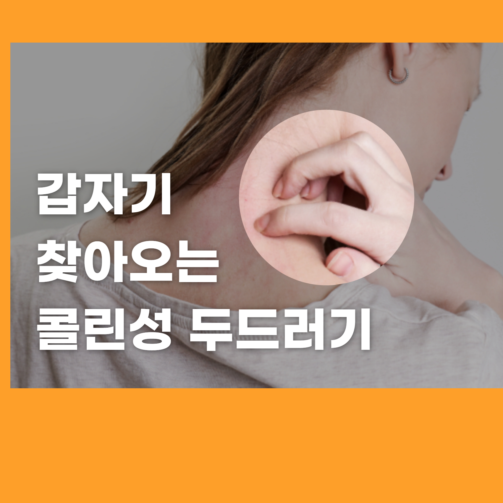 콜린성 두드러기