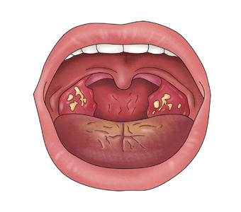 편도결석 증상부터 원인, 치료까지