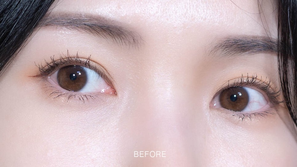 눈밑지방재배치 후기