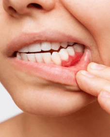 잇몸 염증 치료약