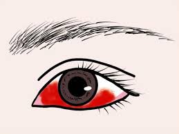 눈 실핏줄이 터지는 이유