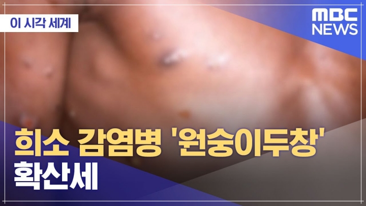원숭이두창에 관한 내용이 담긴 사진입니다.