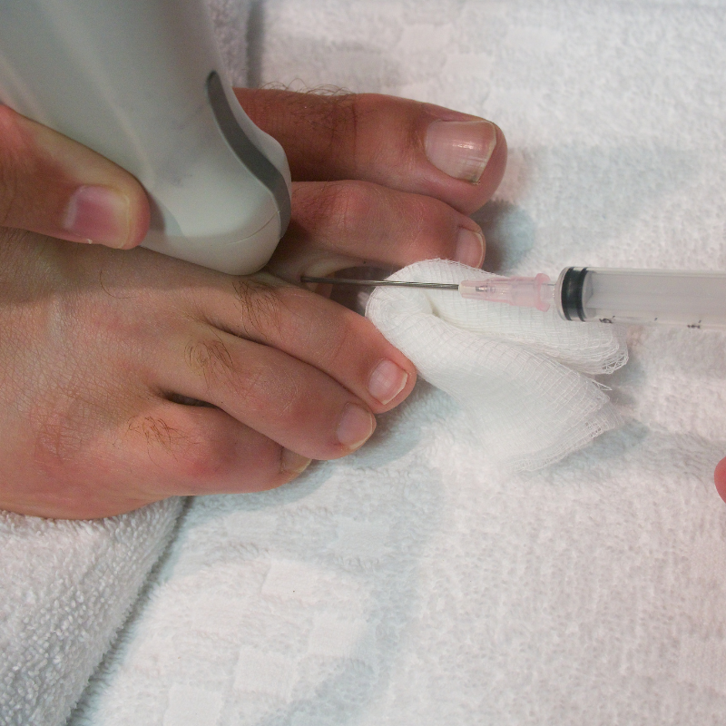 지간신경종 치료