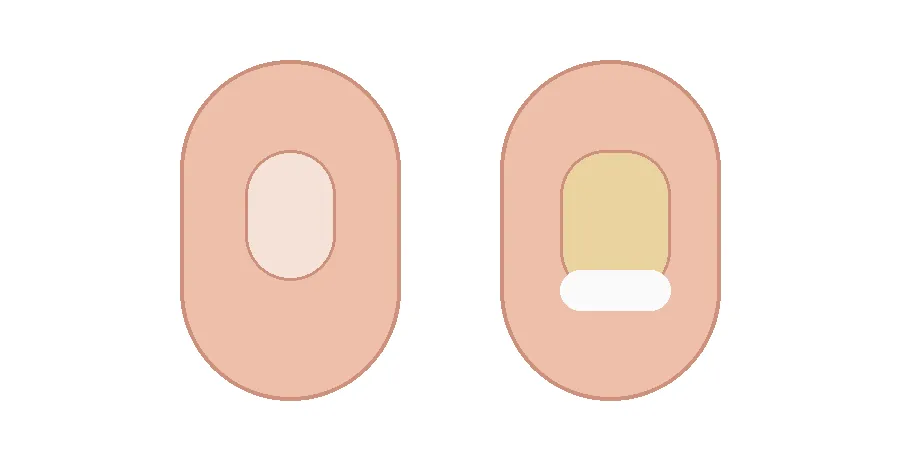 발톱 무좀인 줄 알았는데 아니었다: 헷갈리는 발톱 변화 구분 기준