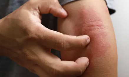 몸이 가려운 이유 3