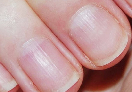세로줄이 생긴 손톱