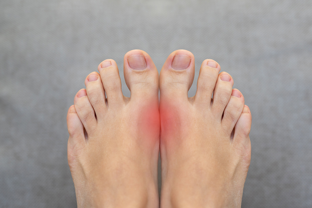 통풍에 좋은 음식