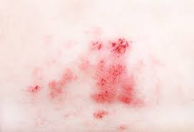 지루성 피부염 완치하려면