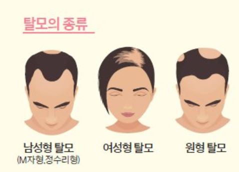 미녹시딜-정-후기