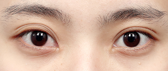 여자 무쌍 눈매 교정